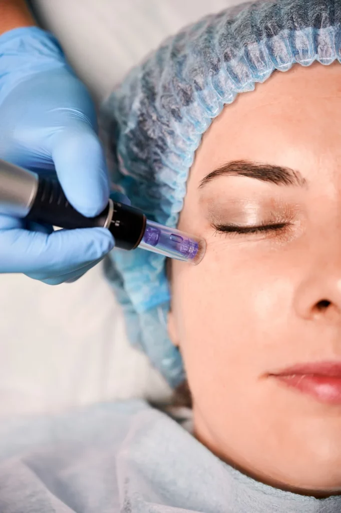 Close-up of a patient receiving Scroler microneedling treatment around the eye area by a professional wearing blue gloves.